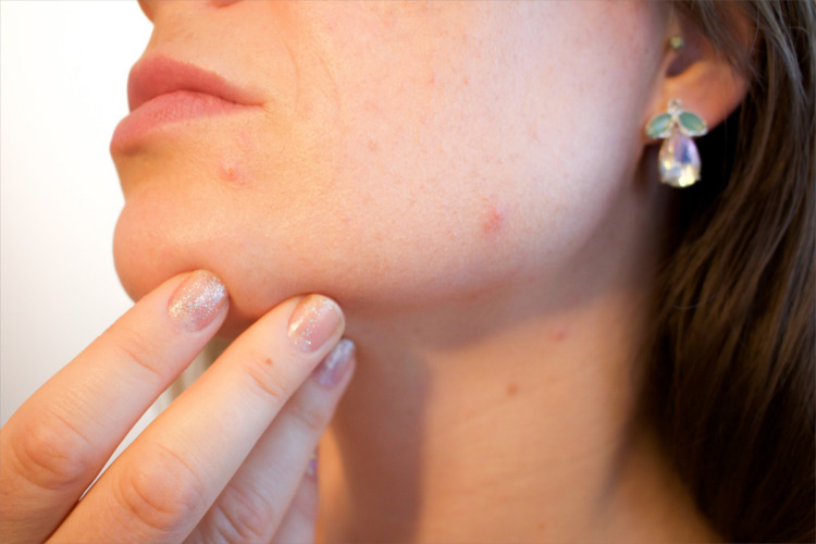Treating Acne at Home