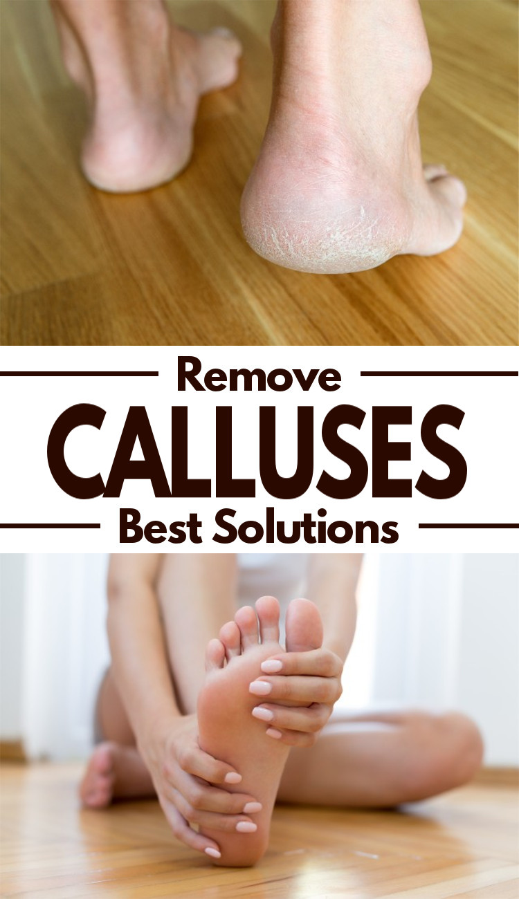 Follow some fruitful home remedies which can help you to get rid of the calluses effectively.
